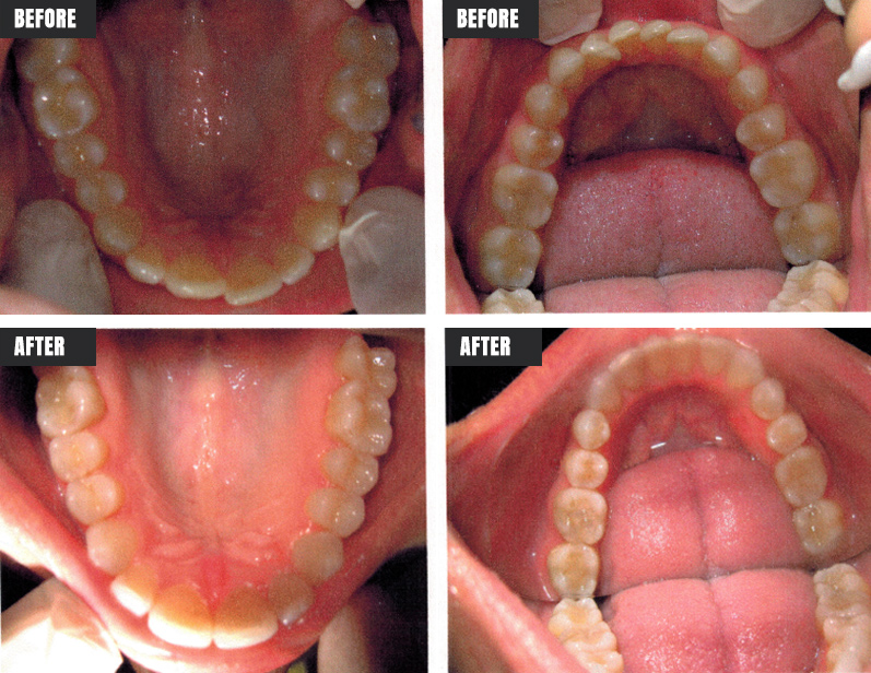 Invisalign - Before & After - Rose M. Feliciano DMD, San Jose Dentist