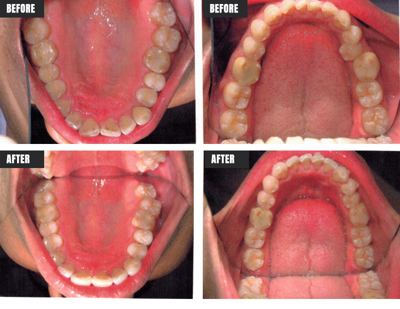 Invisalign - Before & After - Rose M. Feliciano DMD, San Jose Dentist