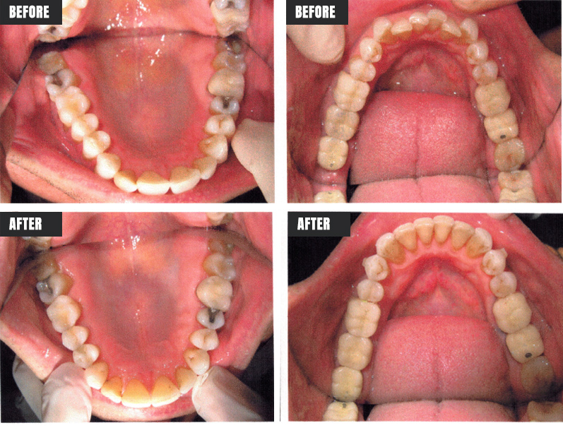 Invisalign - Before & After - Rose M. Feliciano DMD, San Jose Dentist