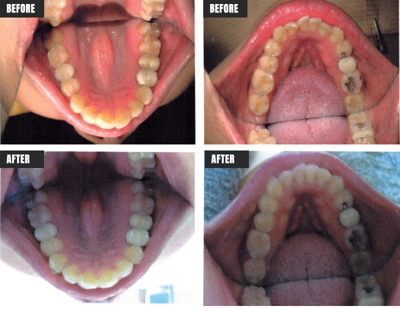 Invisalign - Before & After - Rose M. Feliciano DMD, San Jose Dentist