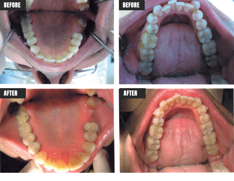 Invisalign - Before & After - Rose M. Feliciano DMD, San Jose Dentist