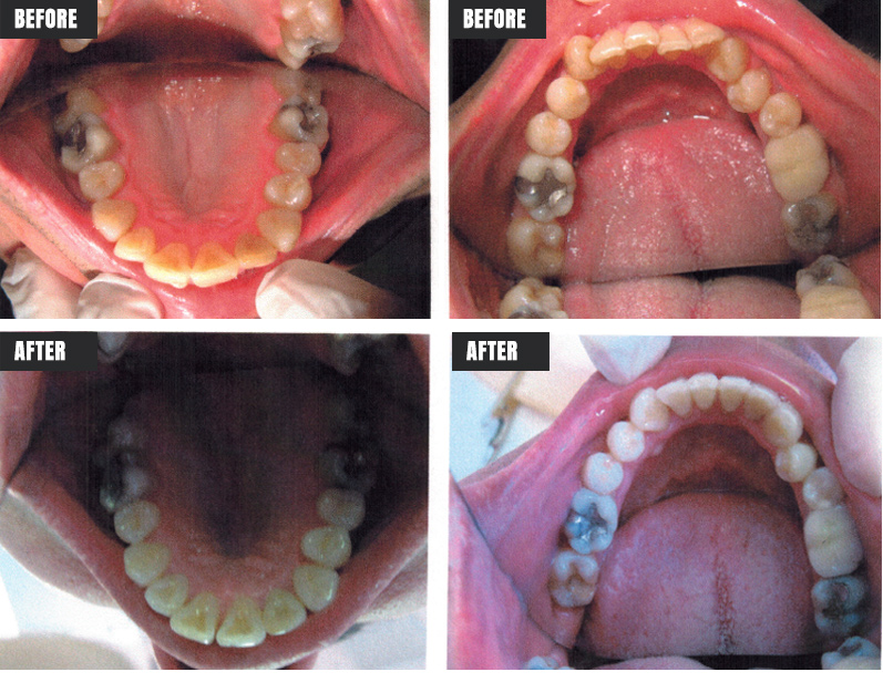 Invisalign - Before & After - Rose M. Feliciano DMD, San Jose Dentist