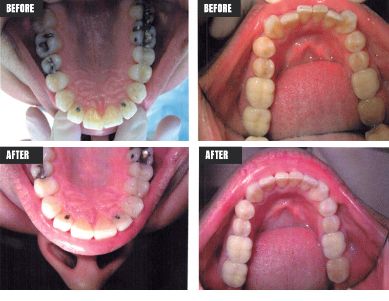 Invisalign - Before & After - Rose M. Feliciano DMD, San Jose Dentist