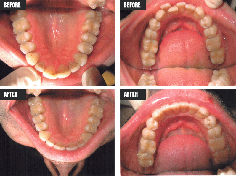 Invisalign - Before & After - Rose M. Feliciano DMD, San Jose Dentist