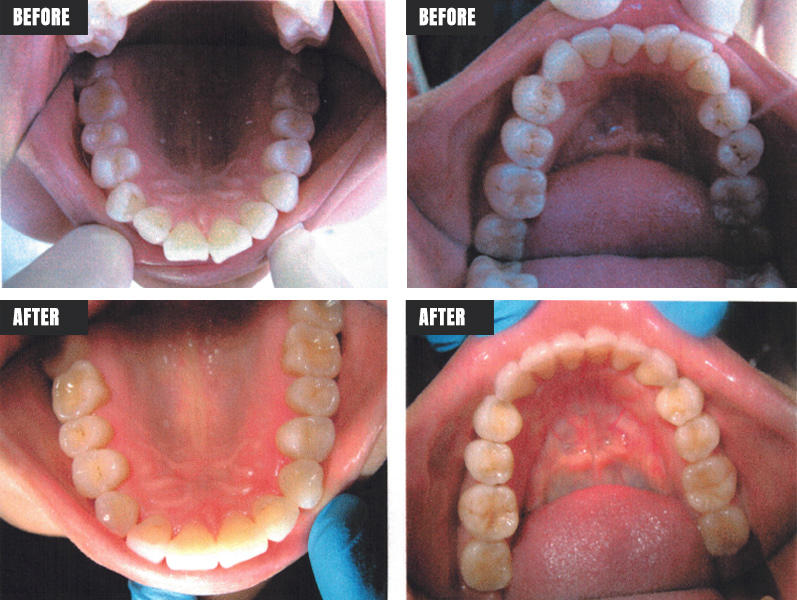 Invisalign - Before & After - Rose M. Feliciano DMD, San Jose Dentist