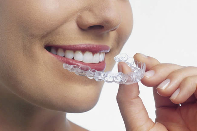 Invisalign - Rose M. Feliciano DMD, San Jose Dentist